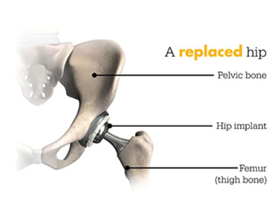 a-replaced-hip