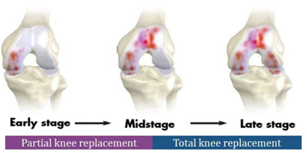 total-knee-vs-partial-knee-replacement